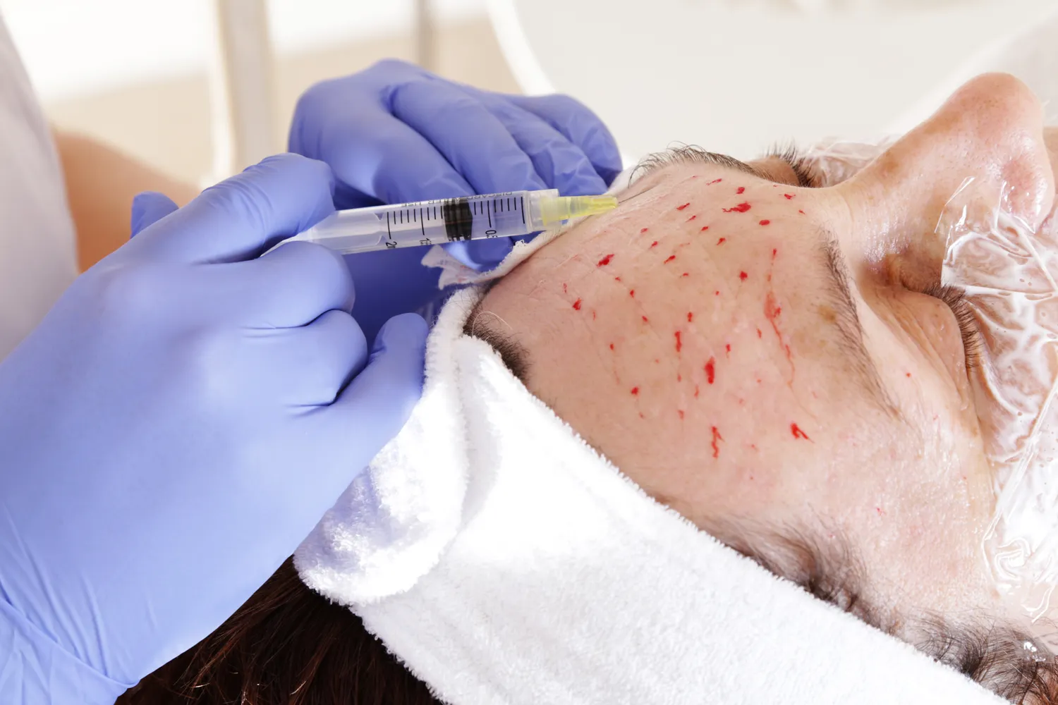 Mezoterapia igłowa Szczecin