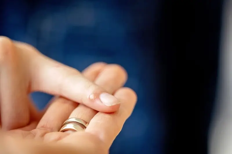 Co na kurzajki i brodawki?